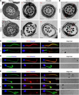 Biallelic Variants in CFAP61 Cause Multiple Morphological Abnormalities of the Flagella and Male Infertility